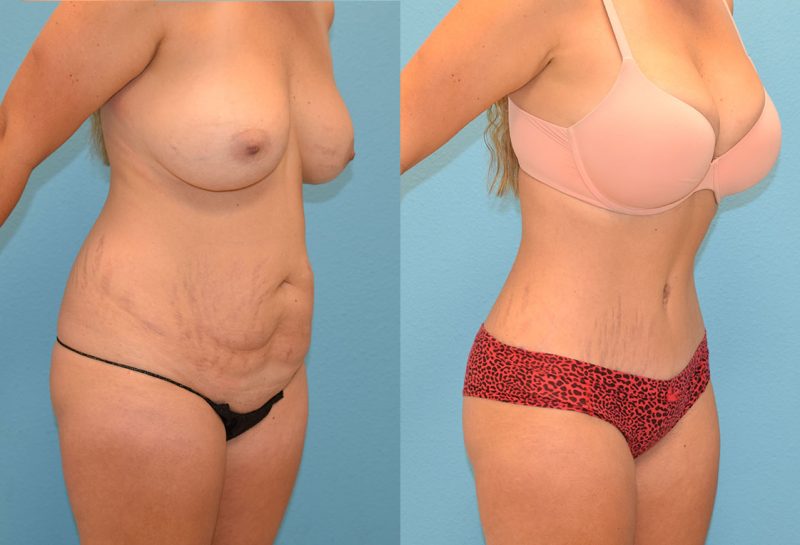 Tummy tuck results by Dr. Maningas at Maningas Cosmetic Surgery in Joplin, MO