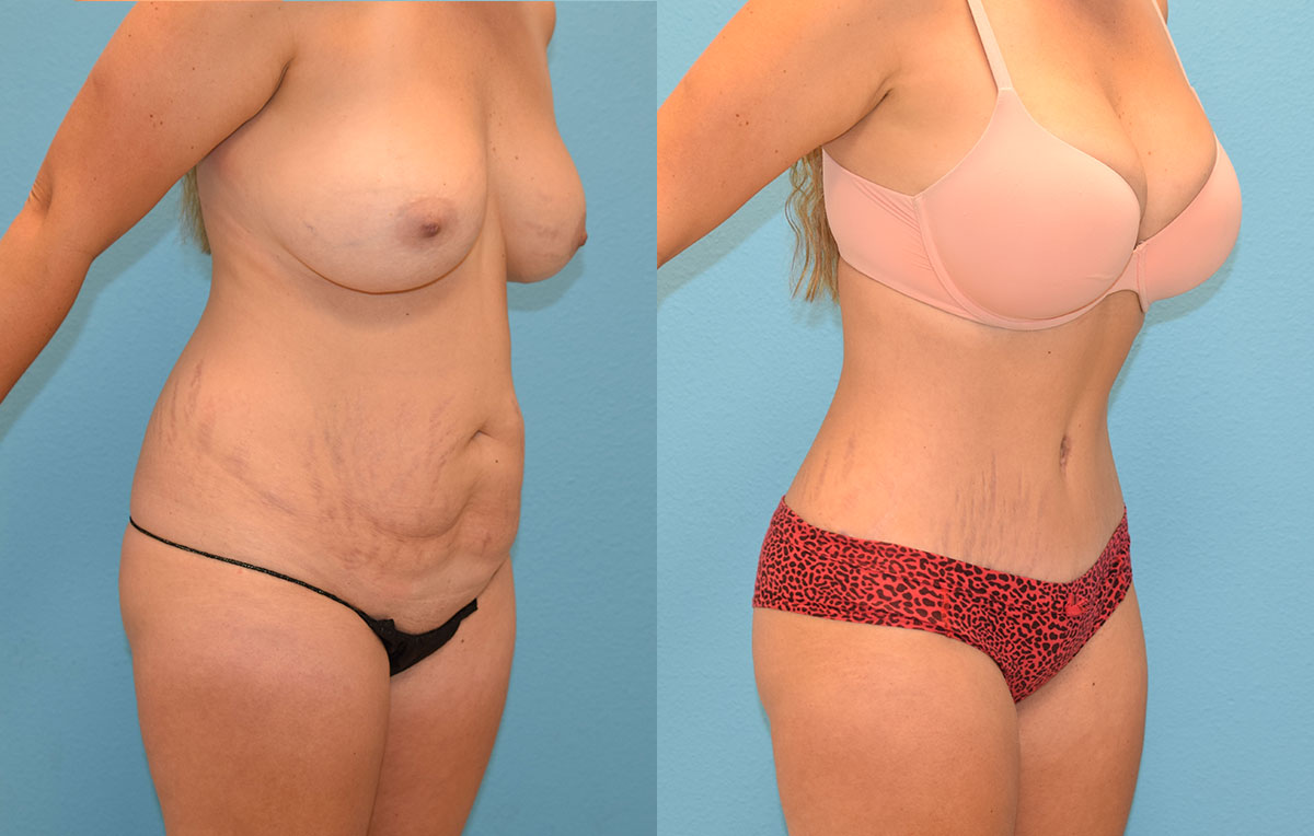 Tummy tuck results by Dr. Maningas at Maningas Cosmetic Surgery in Joplin, MO