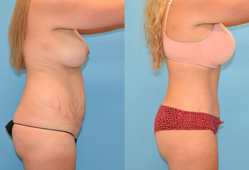 Tummy tuck results by Dr. Maningas at Maningas Cosmetic Surgery in Joplin, MO