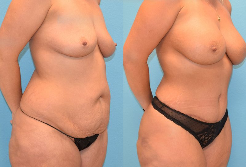 Mommy Makeover, tummy tuck and a breast augmentation with a lift, results by Dr. Maningas at Maningas Cosmetic Surgery in Joplin, MO