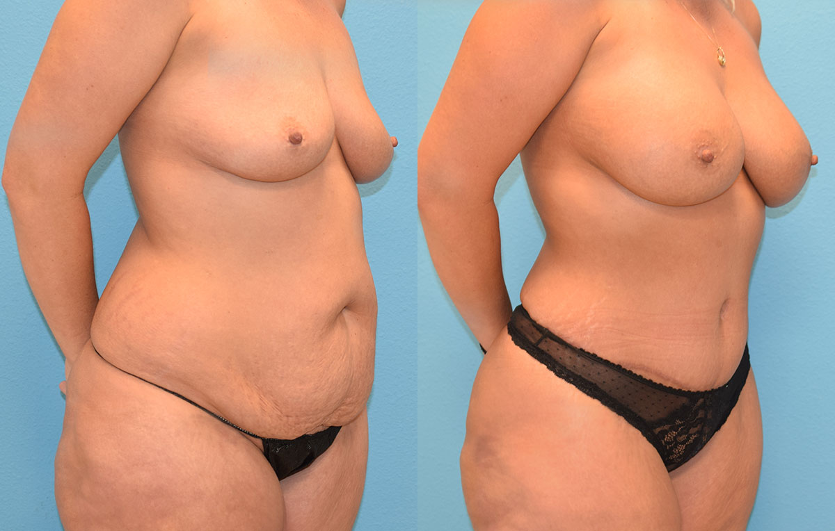 Mommy Makeover, tummy tuck and a breast augmentation with a lift, results by Dr. Maningas at Maningas Cosmetic Surgery in Joplin, MO