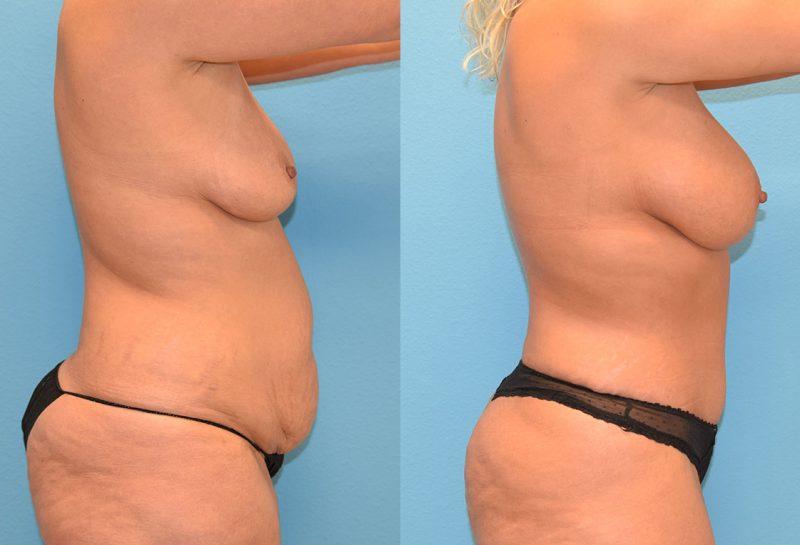 Mommy Makeover, tummy tuck and a breast augmentation with a lift, results by Dr. Maningas at Maningas Cosmetic Surgery in Joplin, MO