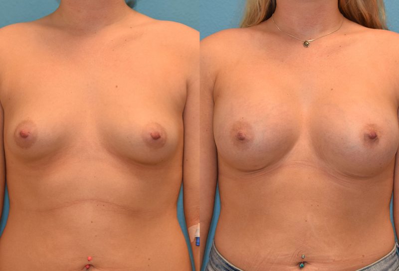 4 months post-op results of a breast augmentation with 450cc implants by Dr. Talon Maningas at Maningas Cosmetic Surgery in Missouri