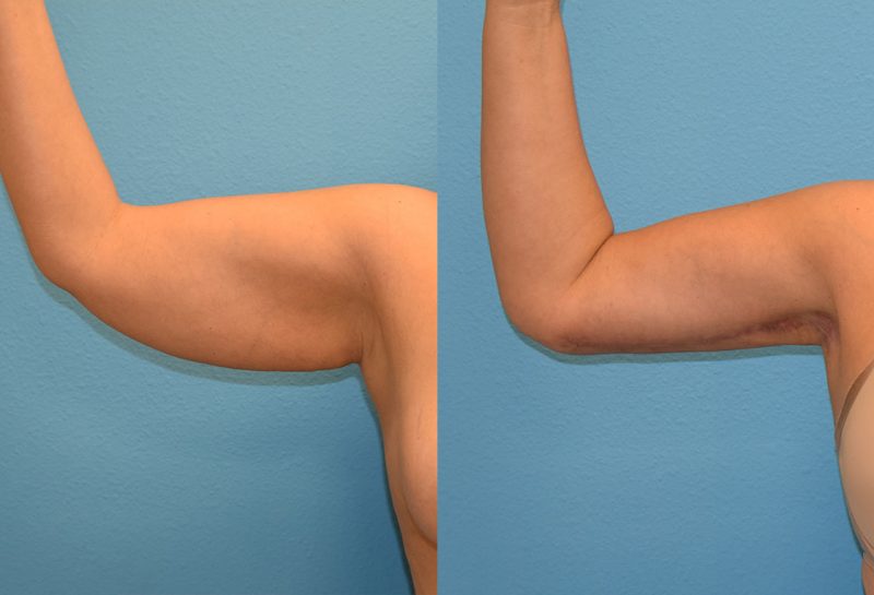 Arm Lift results by Dr. Maningas at Maningas Cosmetic Surgery in Joplin, MO