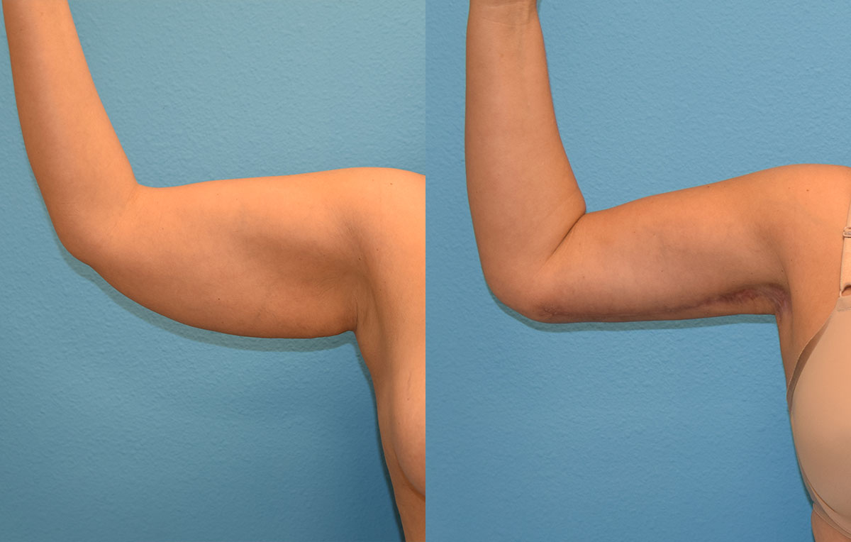 Arm Lift results by Dr. Maningas at Maningas Cosmetic Surgery in Joplin, MO