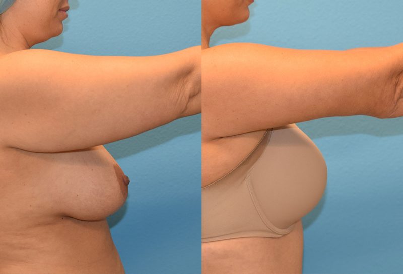 Arm Lift results by Dr. Maningas at Maningas Cosmetic Surgery in Joplin, MO