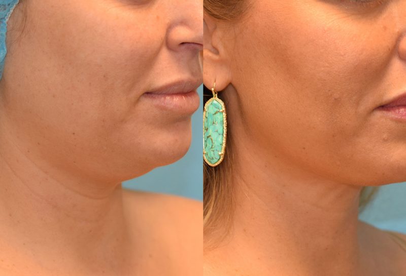 Facetite and Morpheus8, aka EmbraceRF, 4 month results at Maningas Cosmetic Surgery in Joplin, MO.