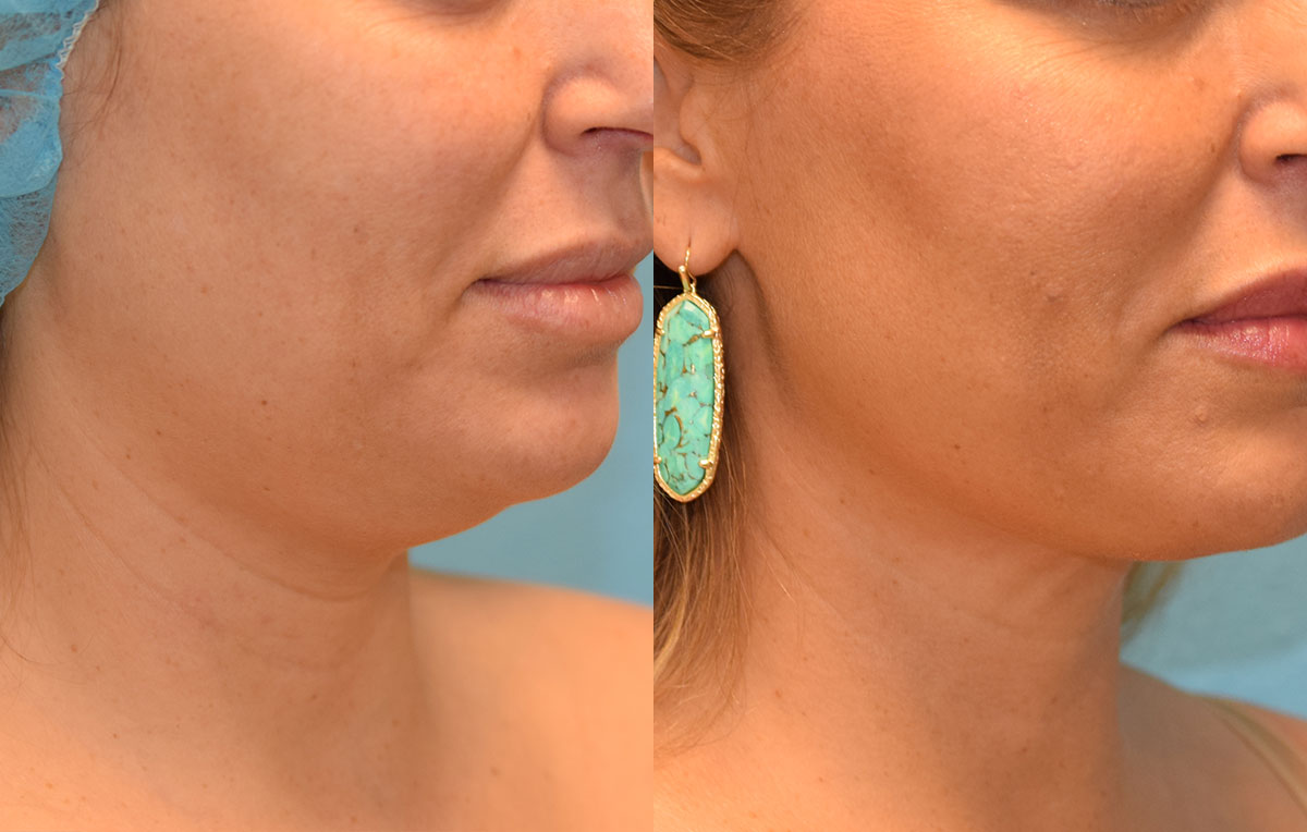 Facetite and Morpheus8, aka EmbraceRF, 4 month results at Maningas Cosmetic Surgery in Joplin, MO.