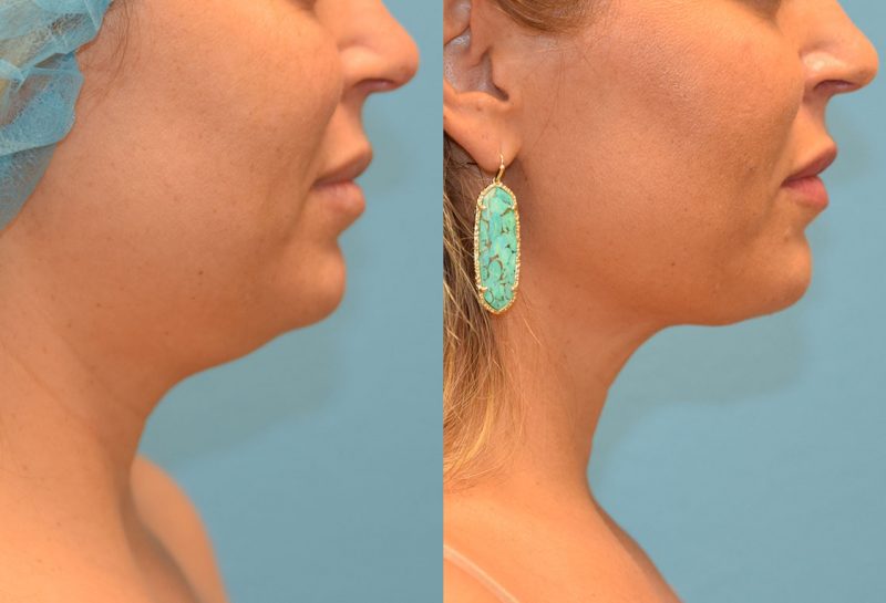 Facetite and Morpheus8, aka EmbraceRF, 4 month results at Maningas Cosmetic Surgery in Joplin, MO.