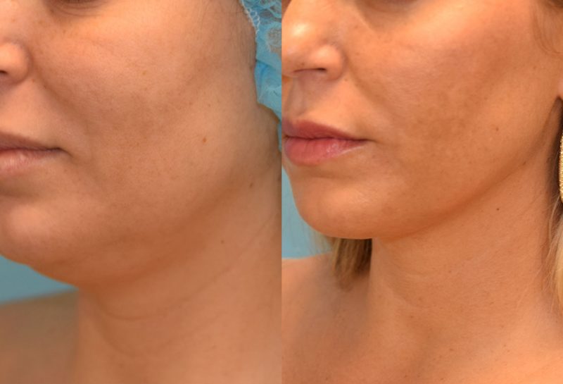 Facetite and Morpheus8, aka EmbraceRF, 4 month results at Maningas Cosmetic Surgery in Joplin, MO.