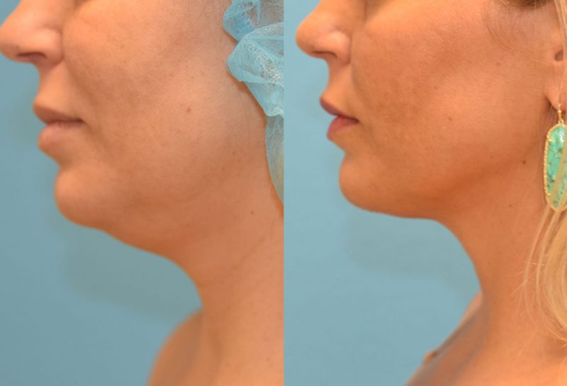 Facetite and Morpheus8, aka EmbraceRF, 4 month results at Maningas Cosmetic Surgery in Joplin, MO.