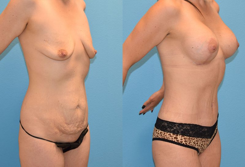 Mommy Makeover, tummy tuck and a breast augmentation with a lift, results by Dr. Maningas at Maningas Cosmetic Surgery in Joplin, MO