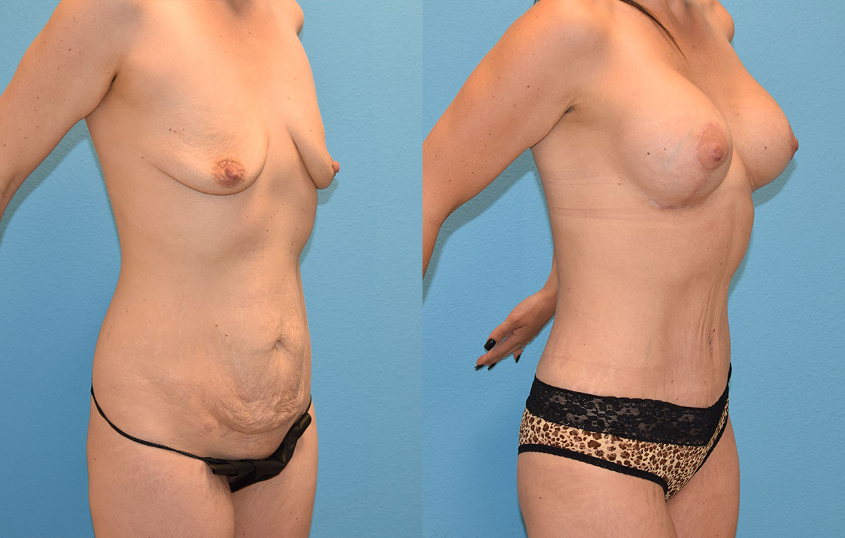 Mommy Makeover, tummy tuck and a breast augmentation with a lift, results by Dr. Maningas at Maningas Cosmetic Surgery in Joplin, MO