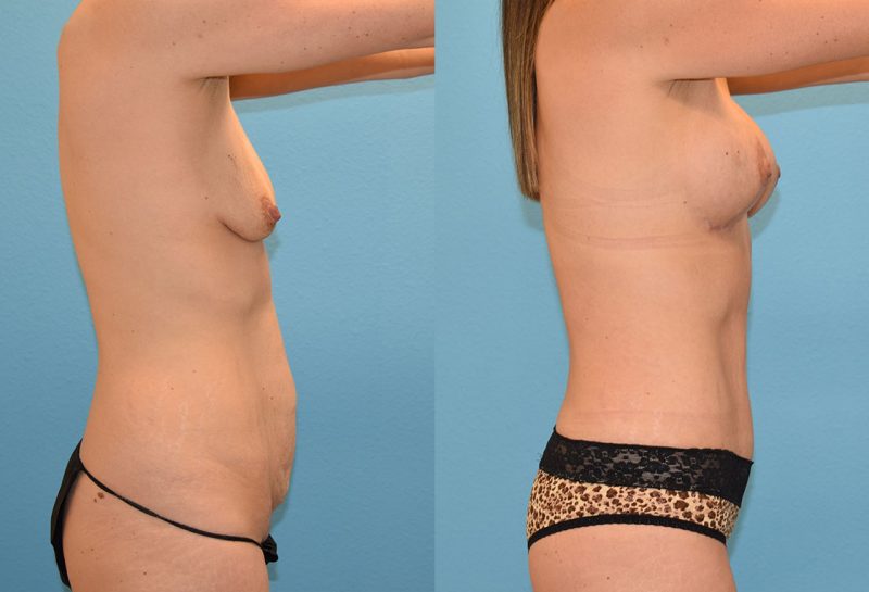 Mommy Makeover, tummy tuck and a breast augmentation with a lift, results by Dr. Maningas at Maningas Cosmetic Surgery in Joplin, MO