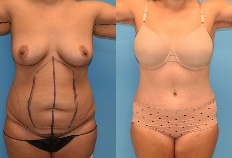 Tummy tuck results by Dr. Maningas at Maningas Cosmetic Surgery in Joplin, MO