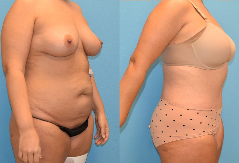 Tummy tuck results by Dr. Maningas at Maningas Cosmetic Surgery in Joplin, MO