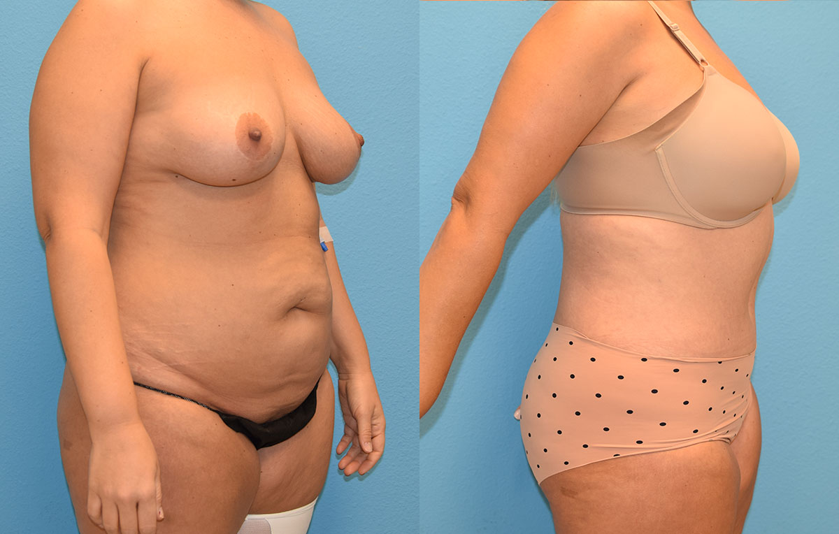 Tummy tuck results by Dr. Maningas at Maningas Cosmetic Surgery in Joplin, MO