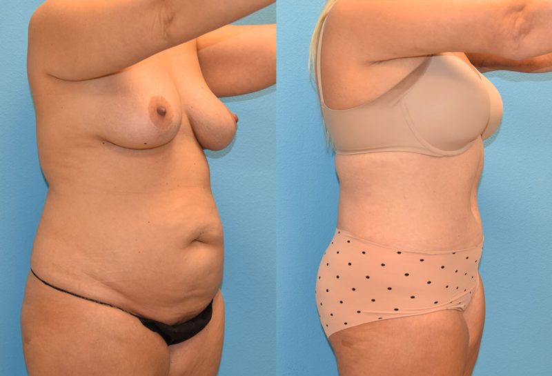 Tummy tuck results by Dr. Maningas at Maningas Cosmetic Surgery in Joplin, MO