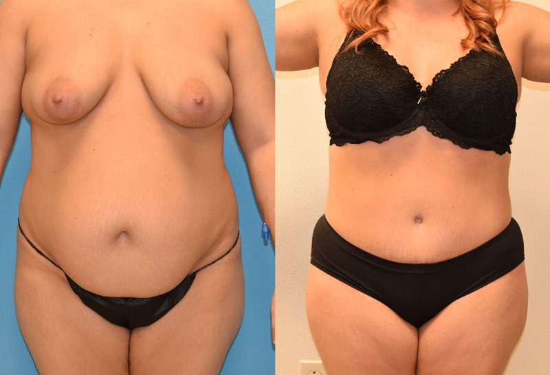 Tummy tuck results by Dr. Maningas at Maningas Cosmetic Surgery in Joplin, MO