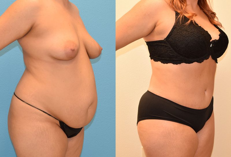 Tummy tuck results by Dr. Maningas at Maningas Cosmetic Surgery in Joplin, MO