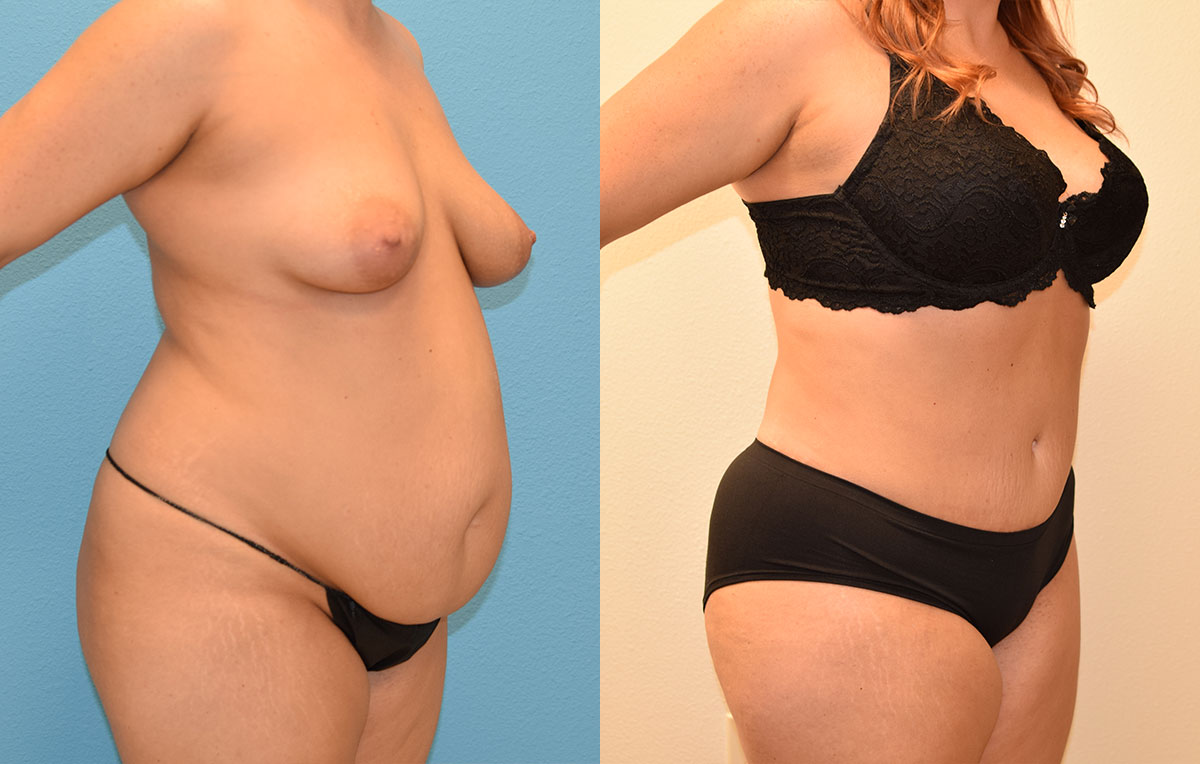 Tummy tuck results by Dr. Maningas at Maningas Cosmetic Surgery in Joplin, MO