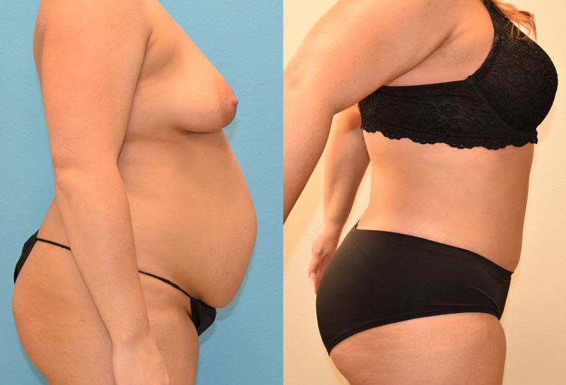 Tummy tuck results by Dr. Maningas at Maningas Cosmetic Surgery in Joplin, MO