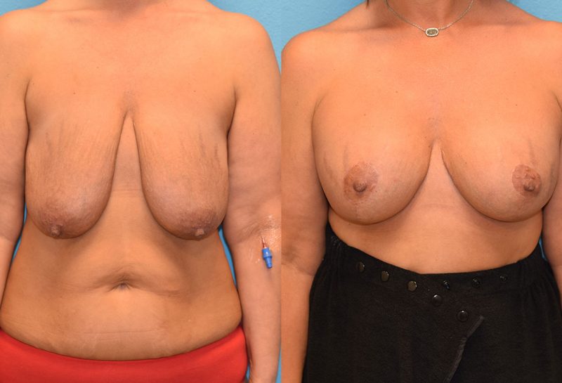 7 months post-op results of a breast lift with 375cc implants by Dr. Talon Maningas at Maningas Cosmetic Surgery in Missouri