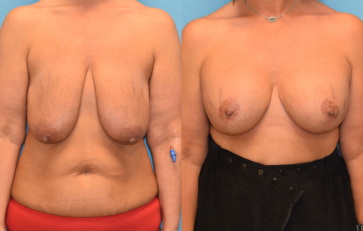 7 months post-op results of a breast lift with 375cc implants by Dr. Talon Maningas at Maningas Cosmetic Surgery in Missouri