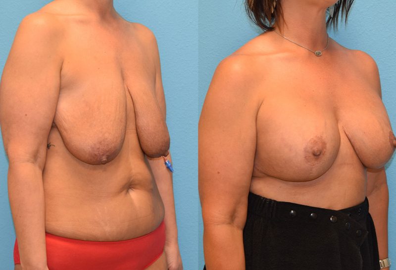 7 months post-op results of a breast lift with 375cc implants by Dr. Talon Maningas at Maningas Cosmetic Surgery in Missouri