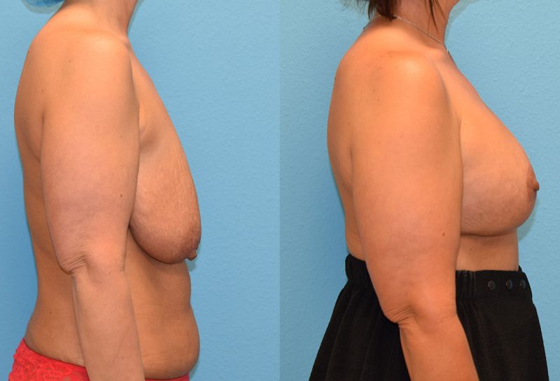 7 months post-op results of a breast lift with 375cc implants by Dr. Talon Maningas at Maningas Cosmetic Surgery in Missouri