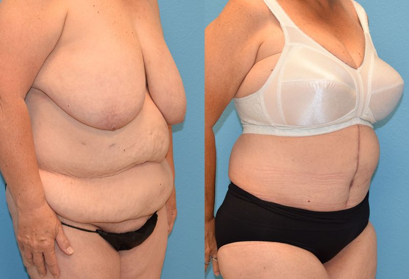 Fleur de lis tummy tuck results by Dr. Maningas at Maningas Cosmetic Surgery in Joplin, MO