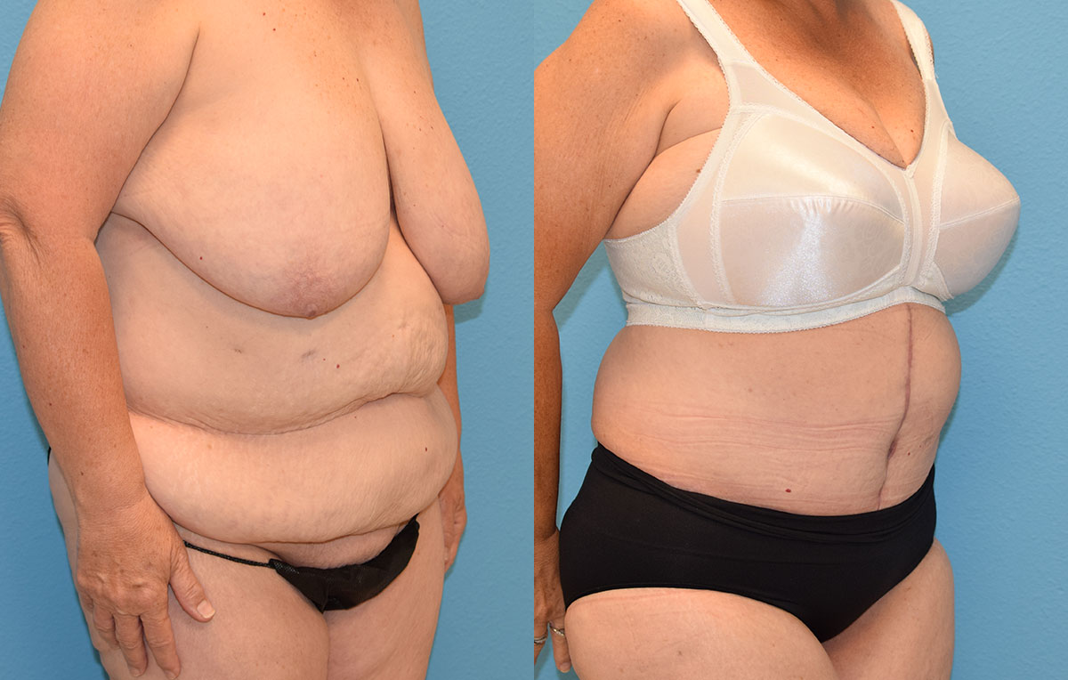 Fleur de lis tummy tuck results by Dr. Maningas at Maningas Cosmetic Surgery in Joplin, MO