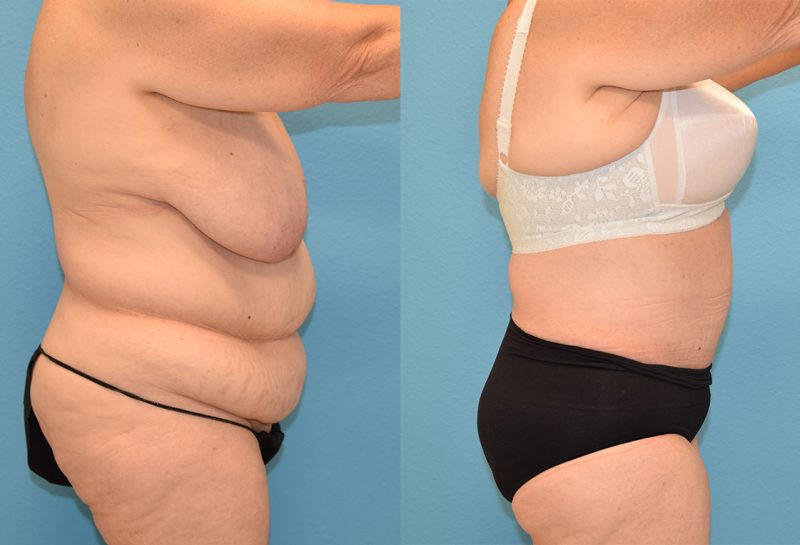 Fleur de lis Tummy tuck results by Dr. Maningas at Maningas Cosmetic Surgery in Joplin, MO