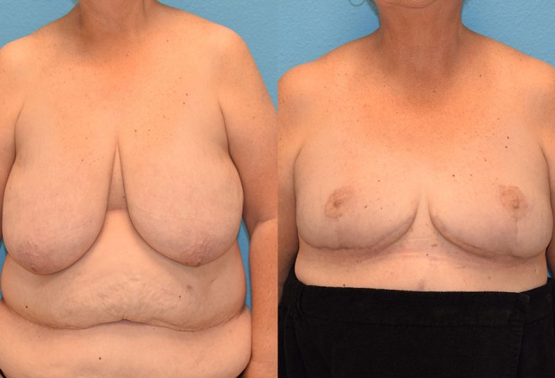 Breast reduction with a lift results by Dr. Maningas at Maningas Cosmetic Surgery in Joplin, MO