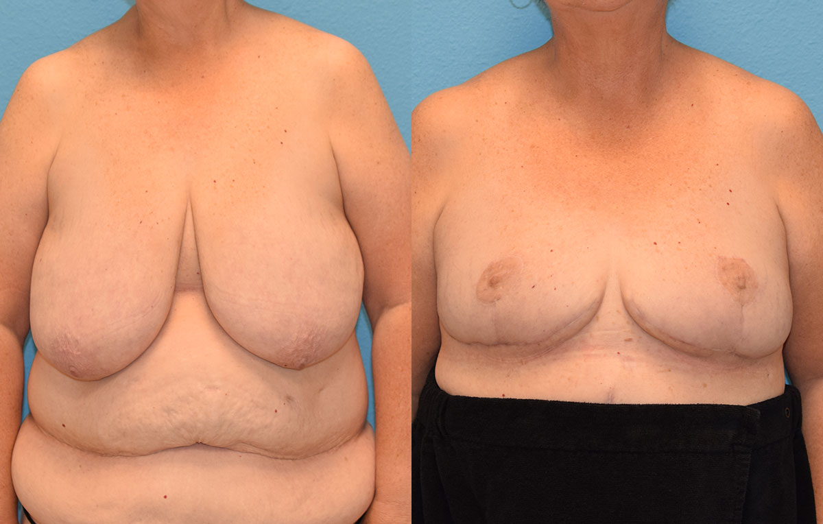 Breast reduction with a lift results by Dr. Maningas at Maningas Cosmetic Surgery in Joplin, MO