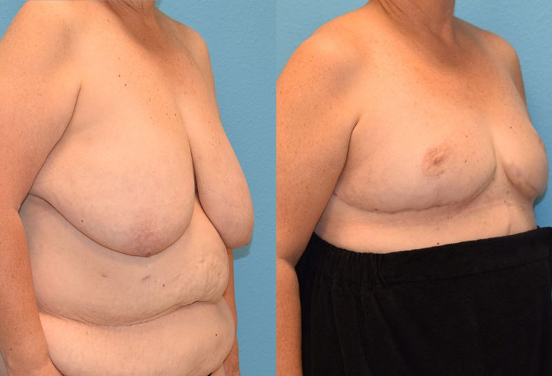 Breast reduction with a lift results by Dr. Maningas at Maningas Cosmetic Surgery in Joplin, MO