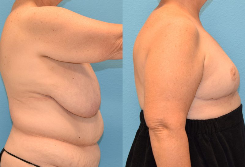 Breast reduction with a lift results by Dr. Maningas at Maningas Cosmetic Surgery in Joplin, MO