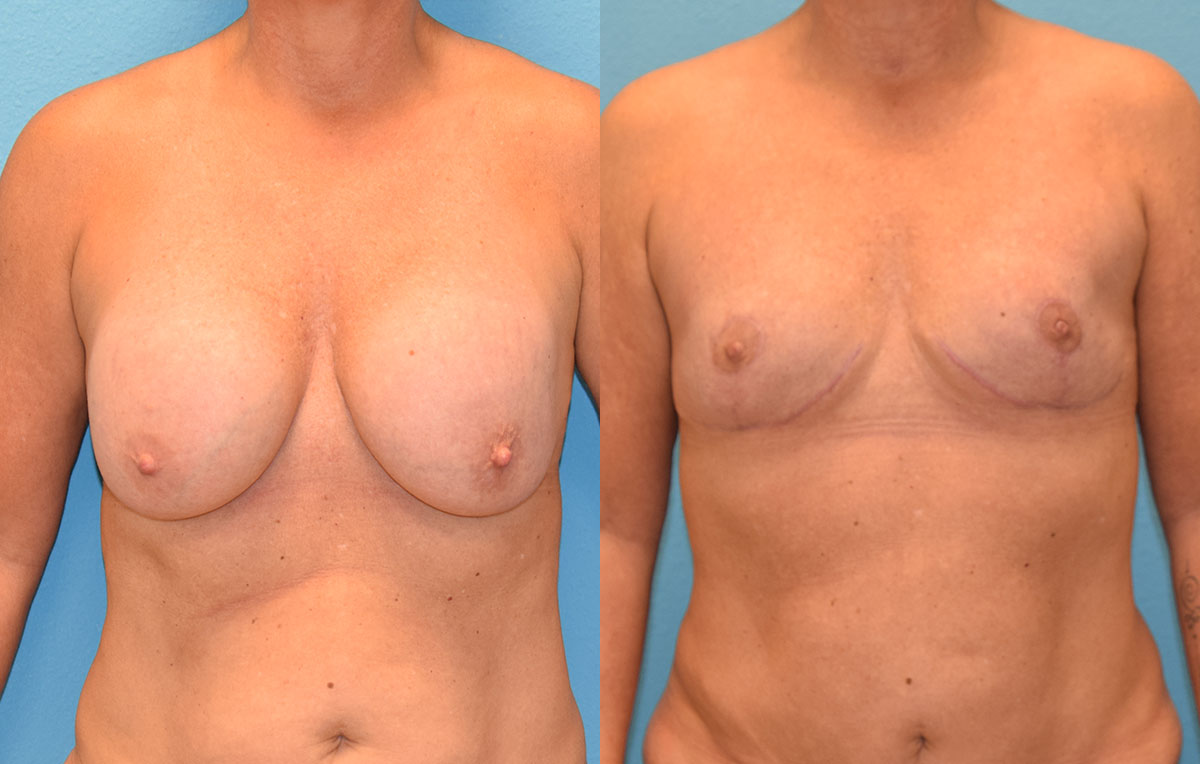 6 months post-op results of an implant implant removal and en bloc capsulectomy with a breast reduction lift by Dr. Maningas at Maningas Cosmetic Surgery in Missouri