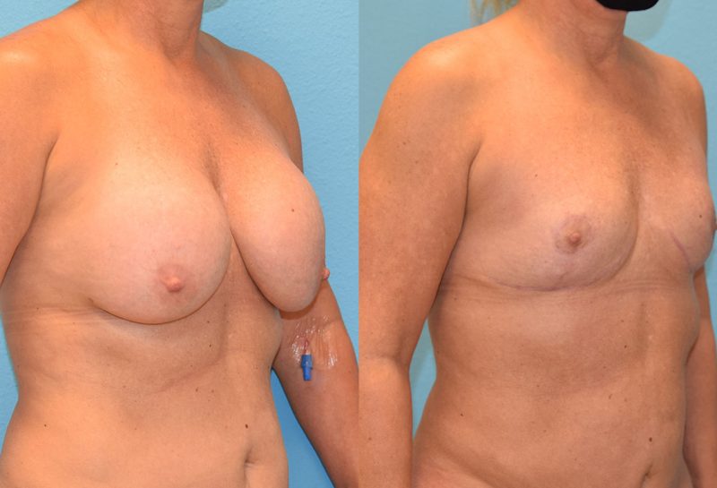 6 months post-op results of an implant implant removal and en bloc capsulectomy with a breast reduction lift by Dr. Maningas at Maningas Cosmetic Surgery in Missouri