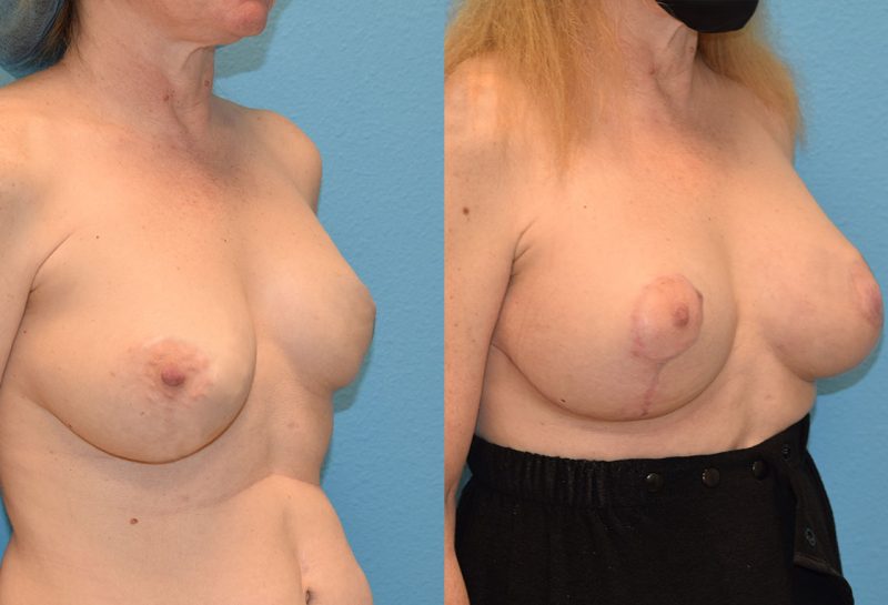 Breast revision surgery including a breast implant exchangeto the left and new implant to the right with fat transfer and a free nipple graft by Dr. Maningas in Joplin, MO