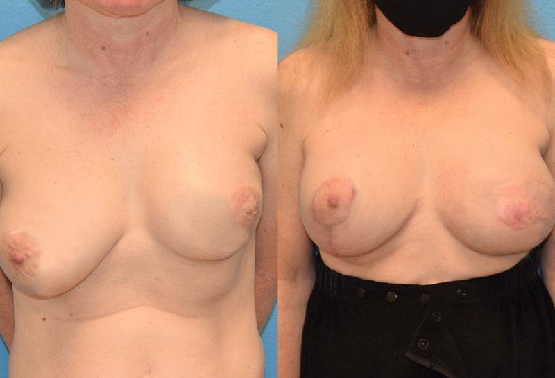 Breast revision surgery including a breast implant exchangeto the left and new implant to the right with fat transfer and a free nipple graft by Dr. Maningas in Joplin, MO