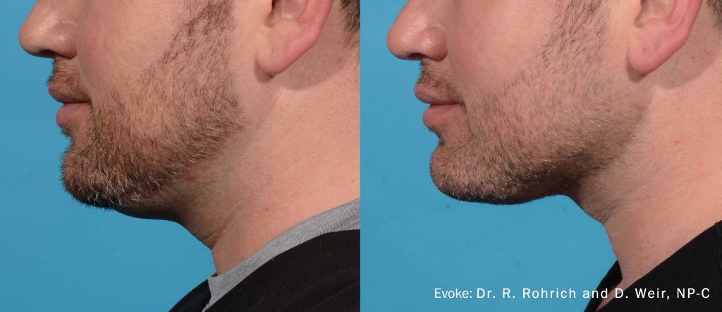 Evoke neck lift