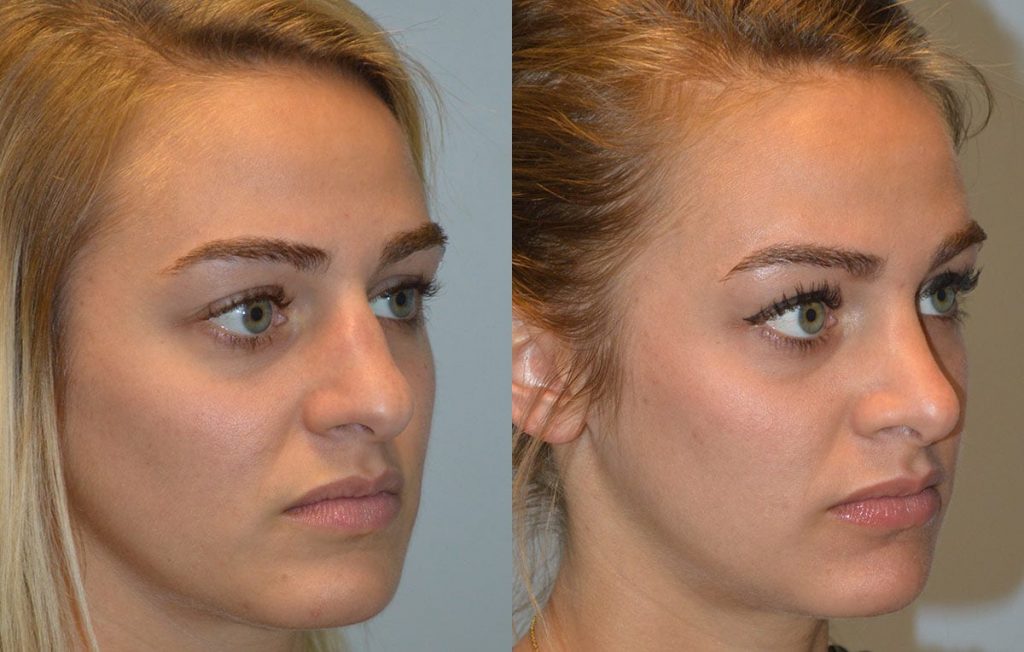 Maningas Cosmetic Surgery Rhinoplasty Patient 465