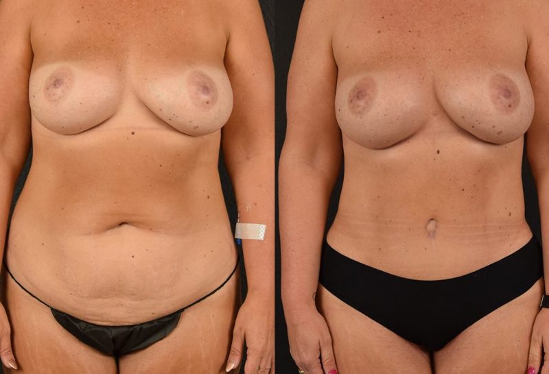 Tummy tuck results by Dr. Maningas at Maningas Cosmetic Surgery in Joplin, MO