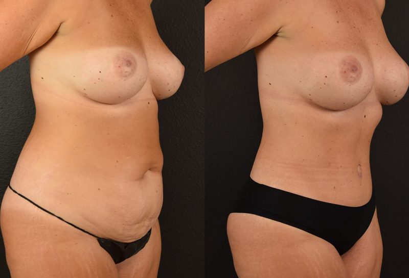 Tummy tuck results by Dr. Maningas at Maningas Cosmetic Surgery in Joplin, MO