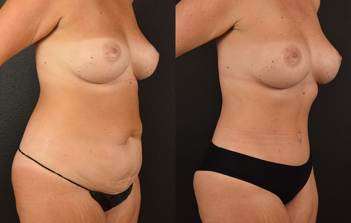 Tummy tuck results by Dr. Maningas at Maningas Cosmetic Surgery in Joplin, MO