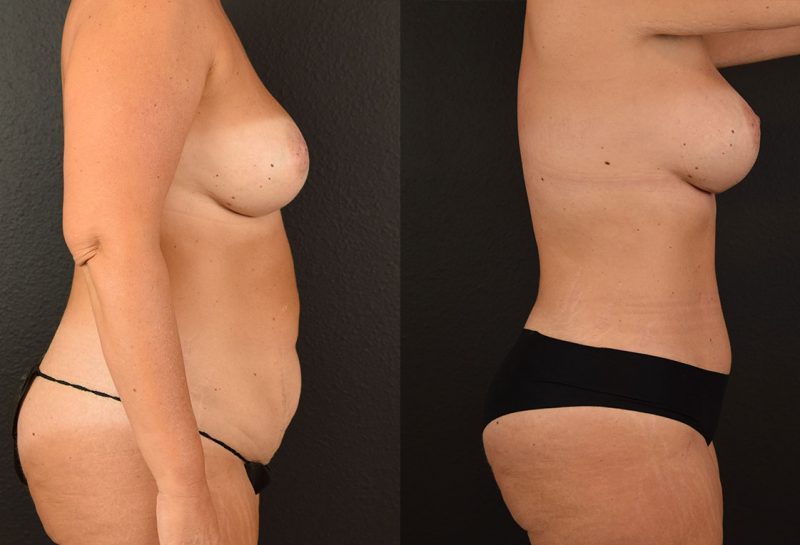 Tummy tuck results by Dr. Maningas at Maningas Cosmetic Surgery in Joplin, MO