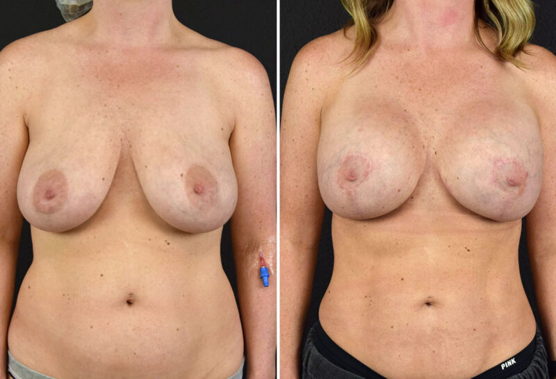 Breast Augmentation with Lift Before and After results