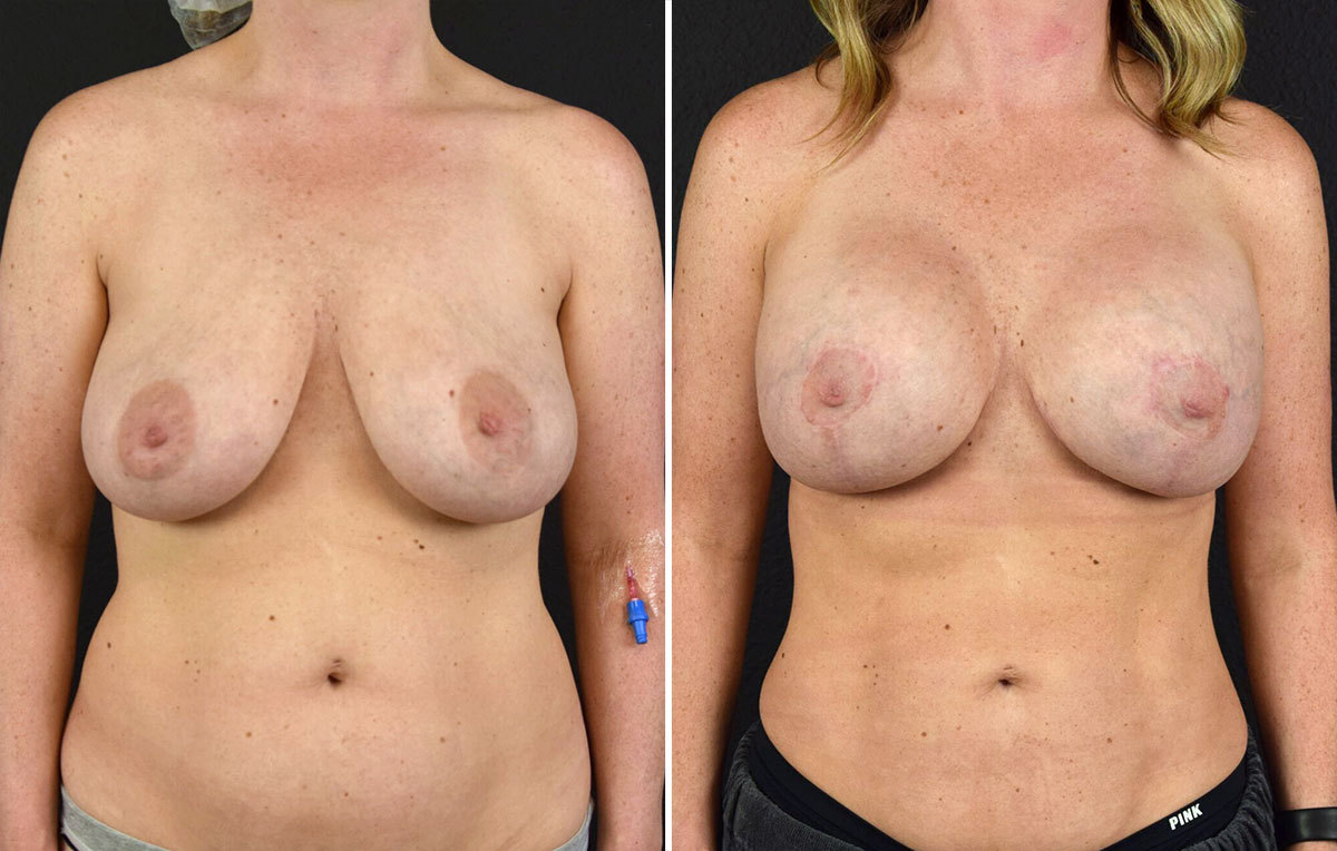 Breast Augmentation with Lift Before and After results