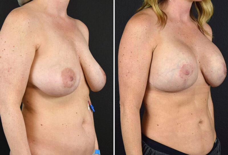 Breast Augmentation with Lift Before and After results